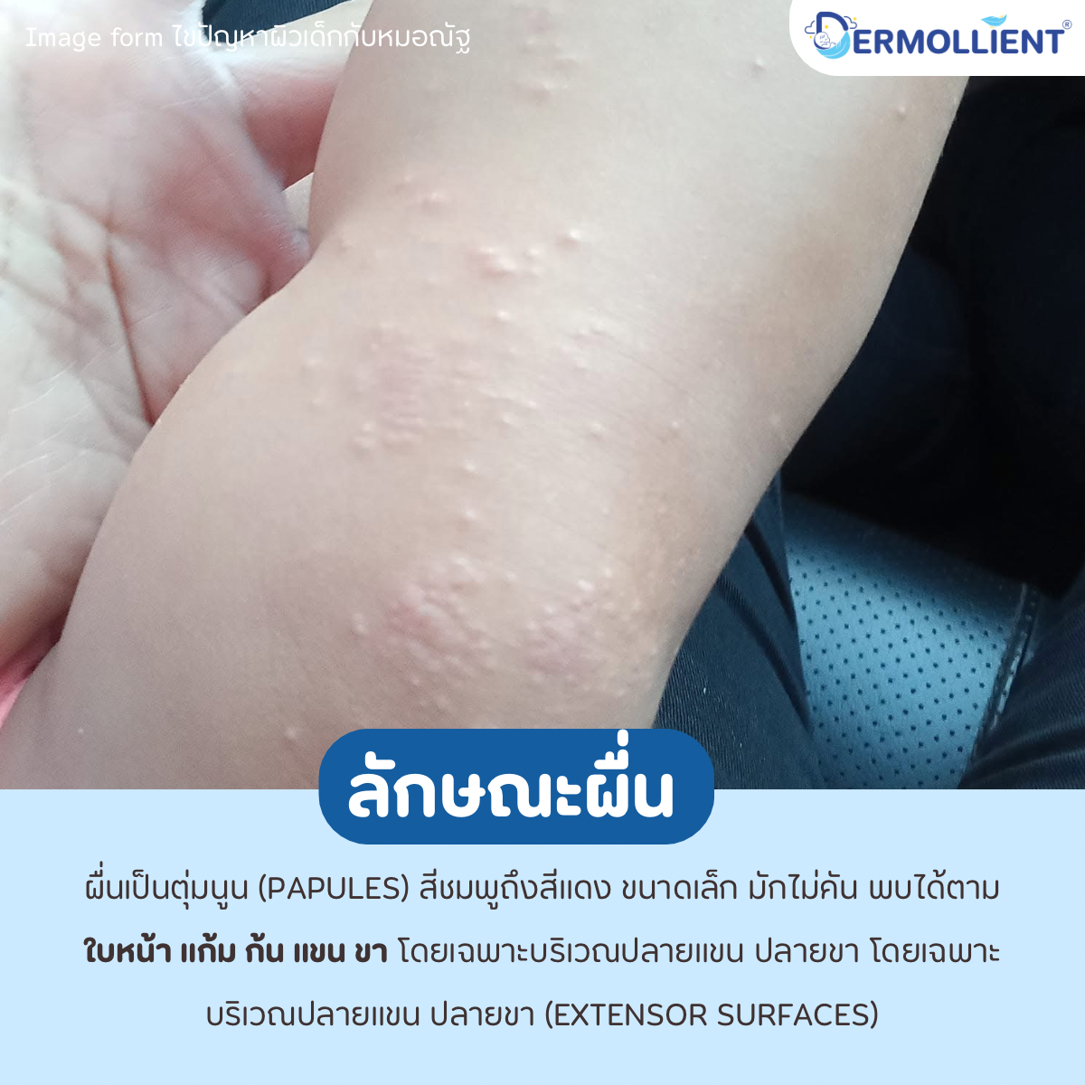 gianotti-crosti-syndrome